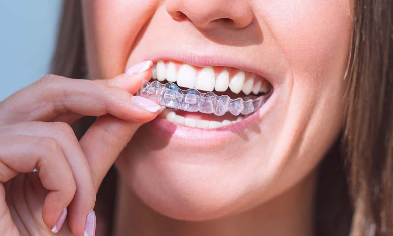 woman putting her clear aligners in