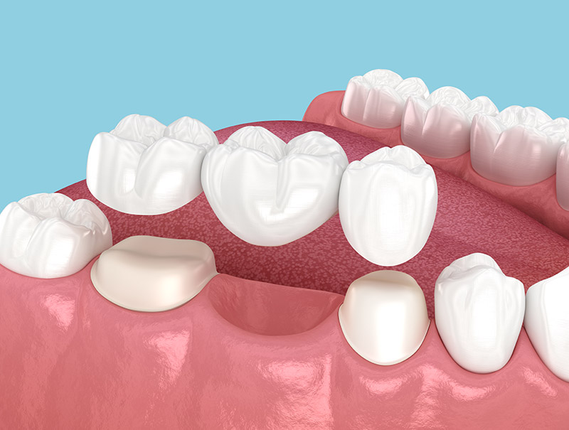 dental bridges Indianapolis, IN