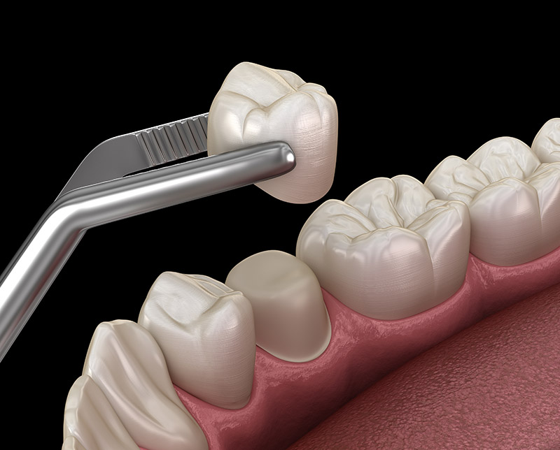 dental crowns Indianapolis, IN