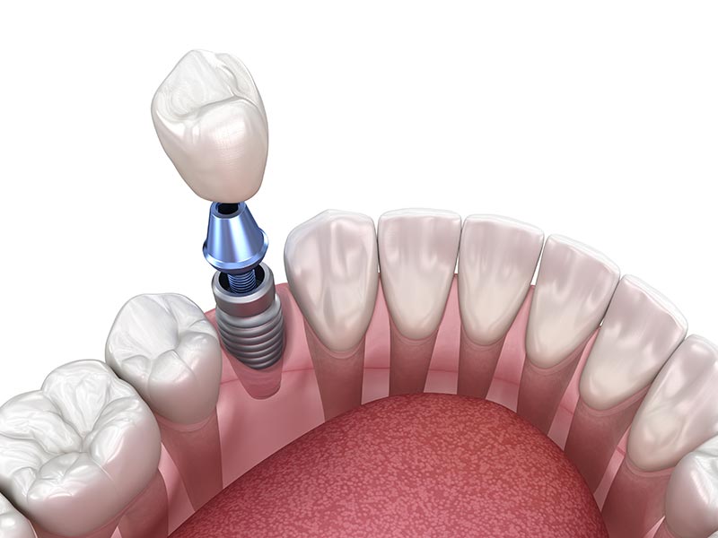 dental implants Indianapolis, IN