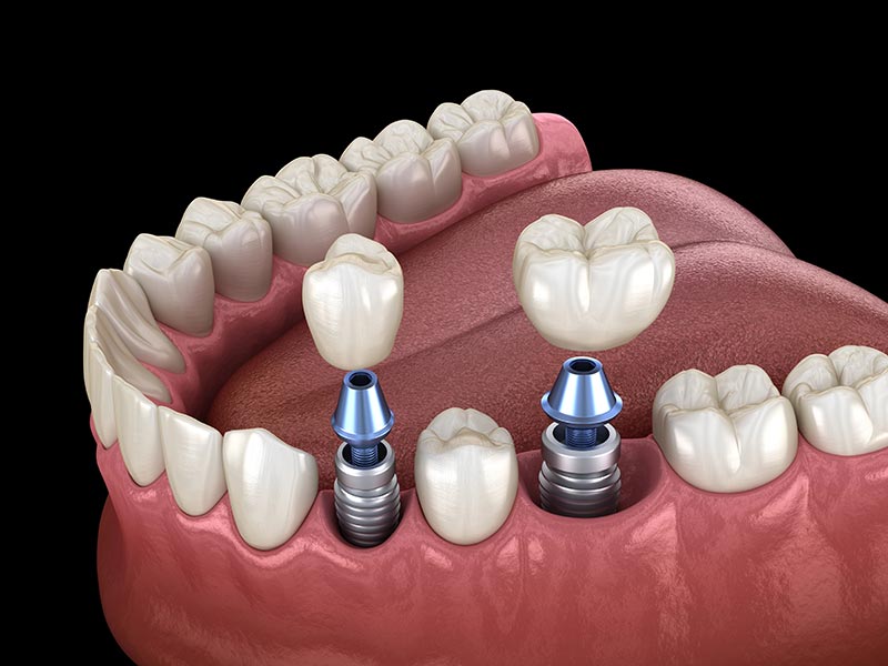 3D model showing how dental implants are placed