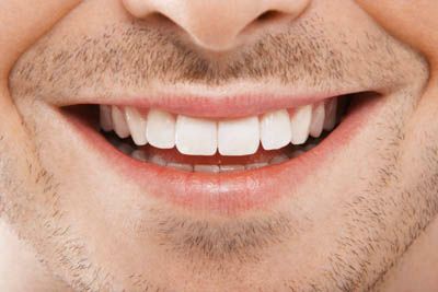 teeth whitening Indianapolis, IN