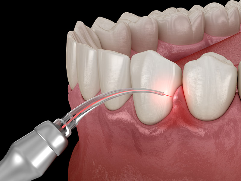 periodontal treatment Indianapolis, IN