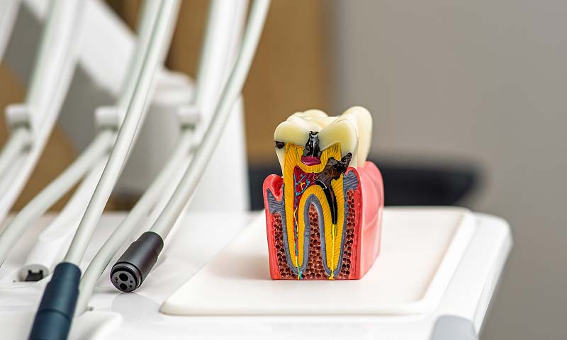 root canal treatment Indianapolis, IN