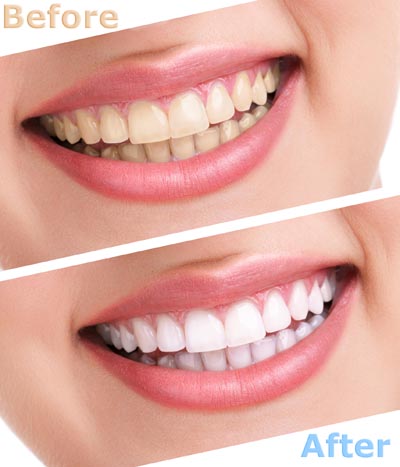 before and after teeth whitening services from Glendale Dental Associates